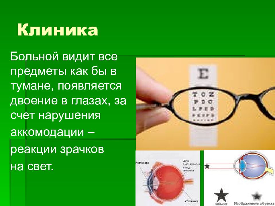 Ра двоение. Двоение контуров предметов. Как видят больные. Туман сетка перед глазами двоение. Ботулизм нарушение аккомодации почему.