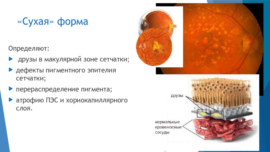 Возрастная макулярная дегенерация презентация