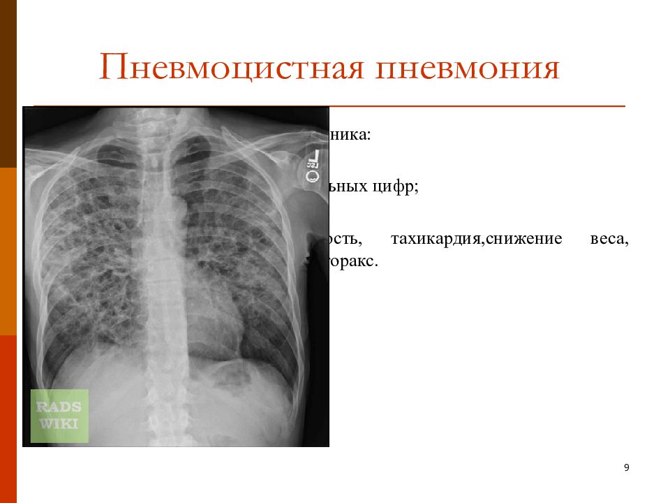 Схема лечения пневмоцистной пневмонии