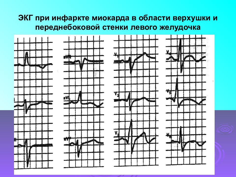 Экг признаки инфаркта миокарда. ЭКГ при ишемии и инфаркте. В рубцовый период инфаркта миокарда на ЭКГ. Инфаркт миокарда на ЭКГ расшифровка.