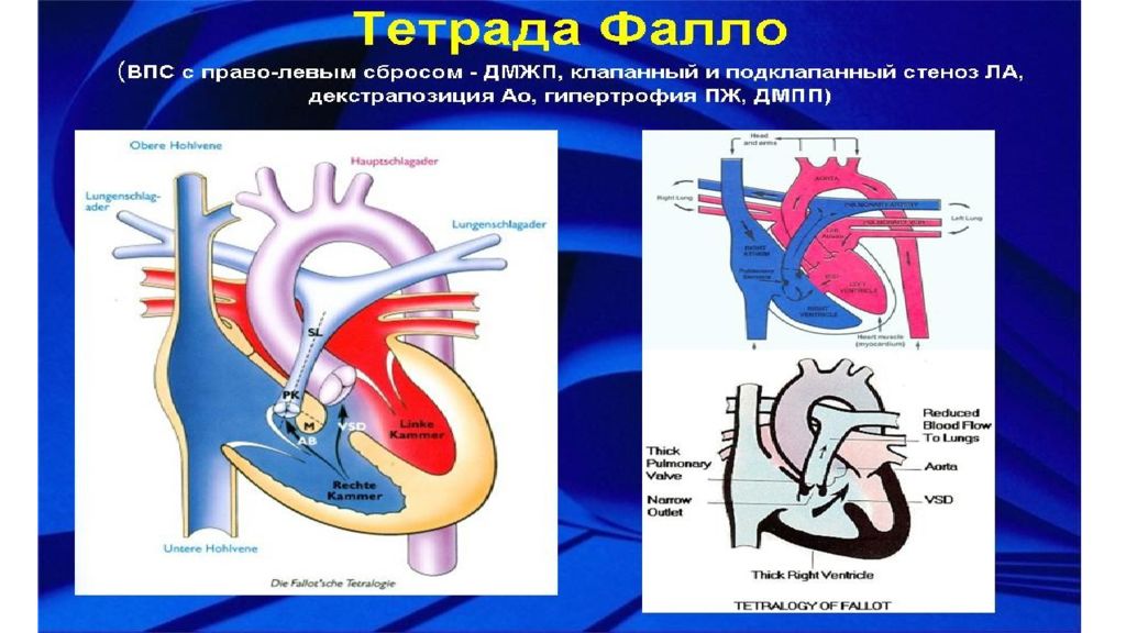 Тетрада фалло у детей