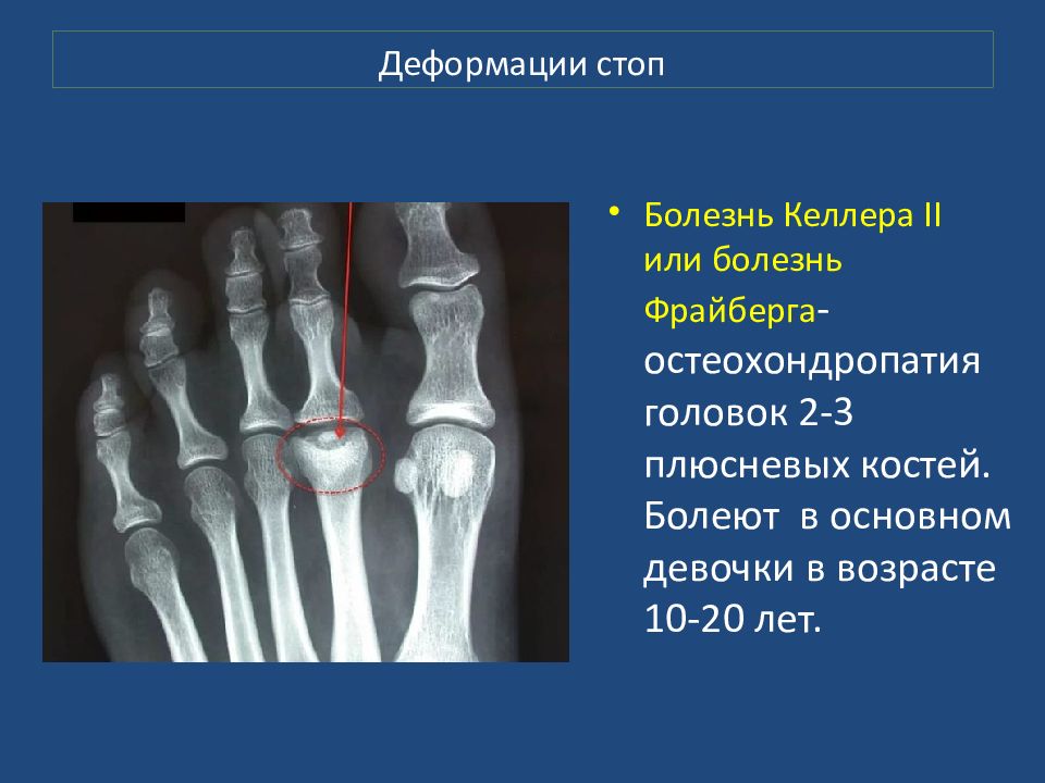 Презентация перелом стопы