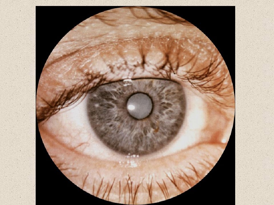 Катаракта глаза что это. Старческая(сенильная)катаракта. Катаракта на радужке глаза.
