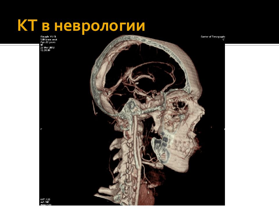 Компьютерная томография в неврологии презентация