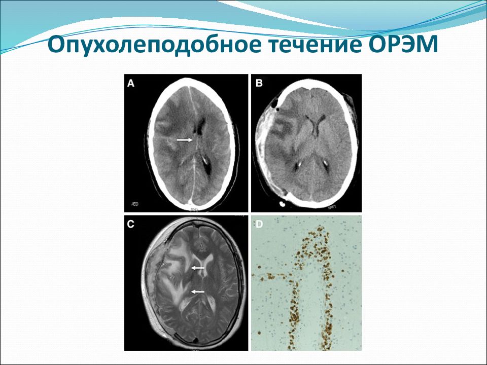 Острый рассеянный энцефаломиелит презентация