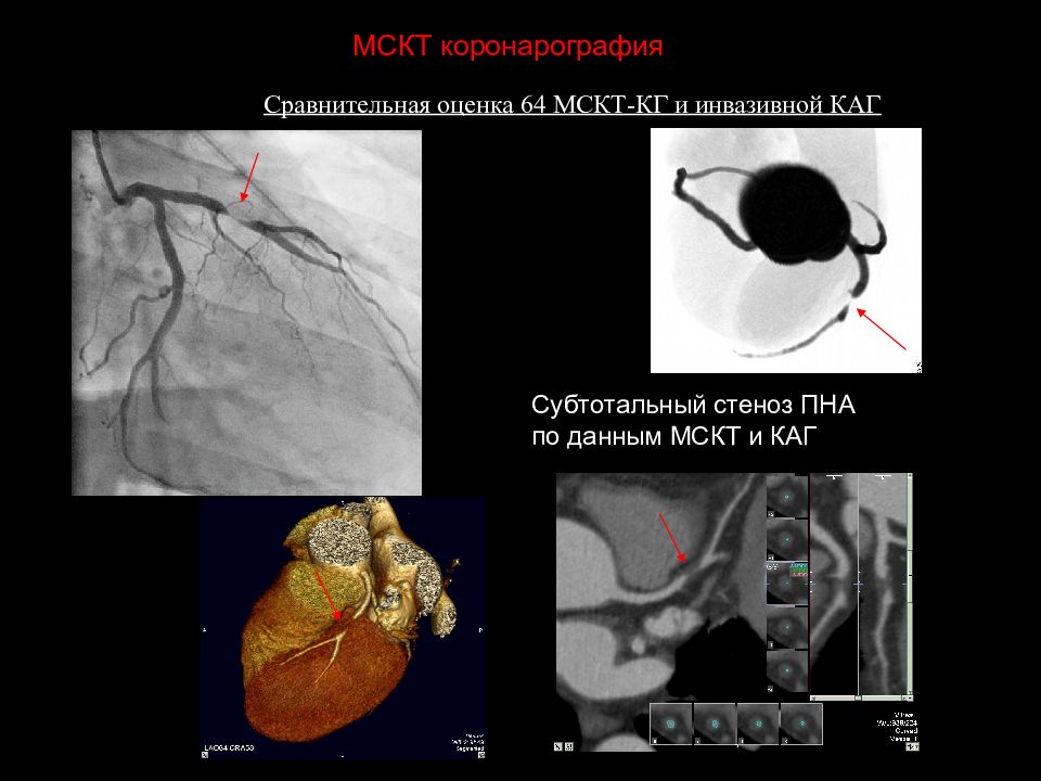 Стеноз пна. Коронарография стеноз. Субтотальный стеноз сонной артерии. Коронарография стеноз ПНА.