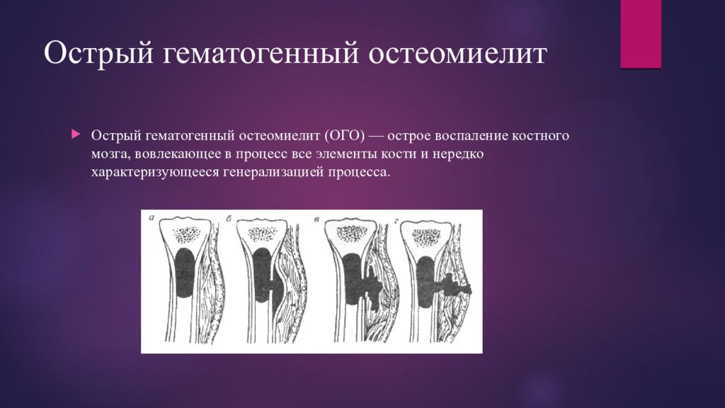 Гематогенный. Гематогенный остеомиелит хирургия. Гематогенный метаэпифизарный остеомиелит. Острый гематогенный эпифизарный остеомиелит. Острый гематогенный остеомиелит схема.