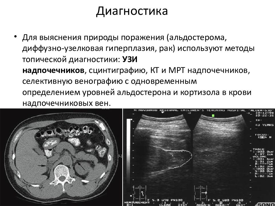 Опухоли надпочечников презентация