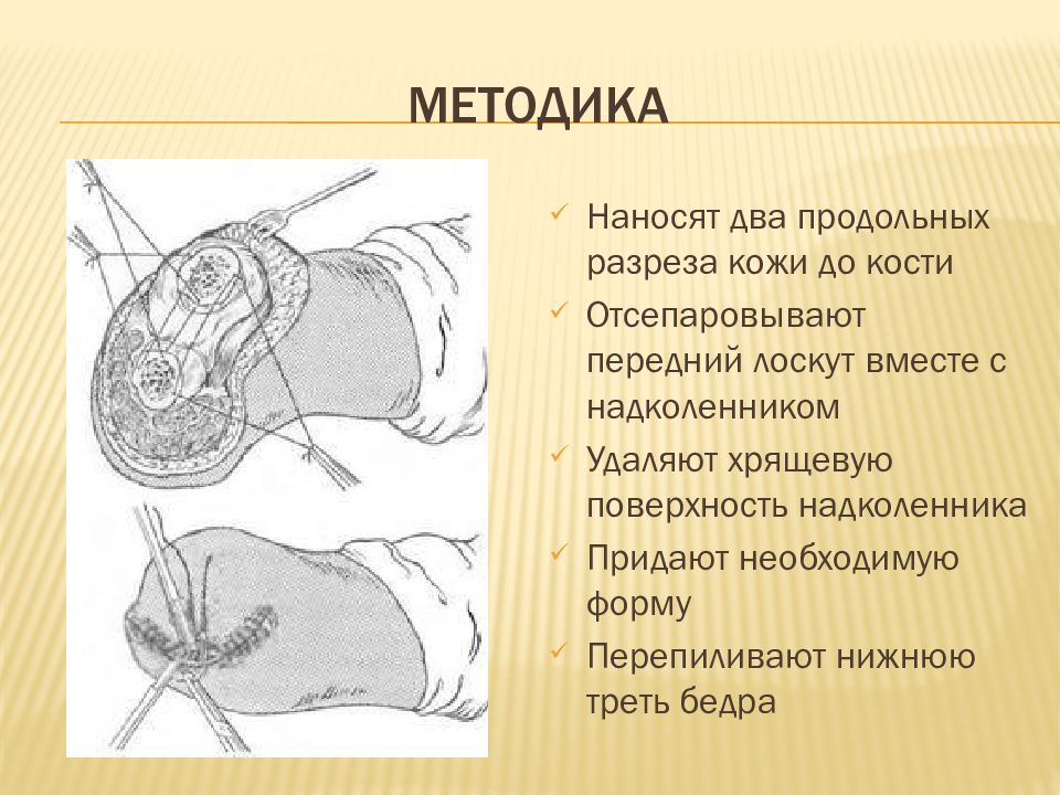 Ампутация плеча презентация