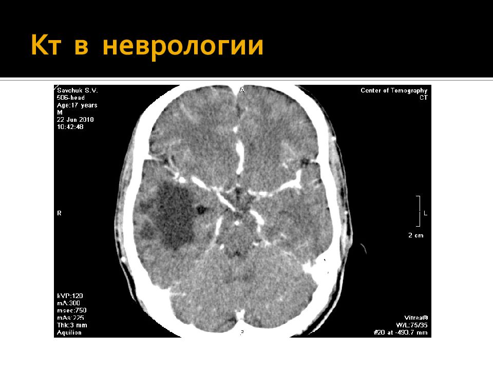 Компьютерная томография в неврологии презентация