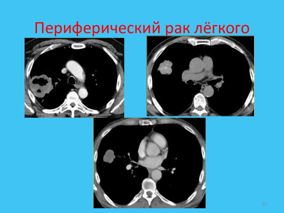 Периферический легких. Периферическая карцинома легких кт.