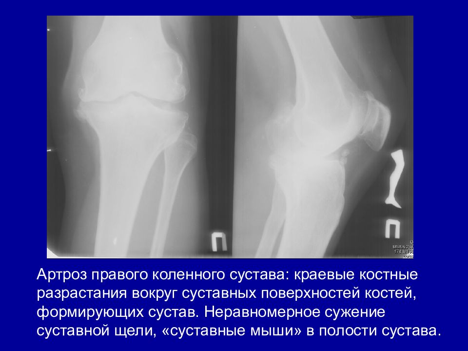 Правого коленного. Артроз пателлофеморального сочленения коленного сустава рентген. Суставная мышь рентген. Суставная мышь коленного сустава рентген протокол. Краевые разрастания суставных поверхностей.