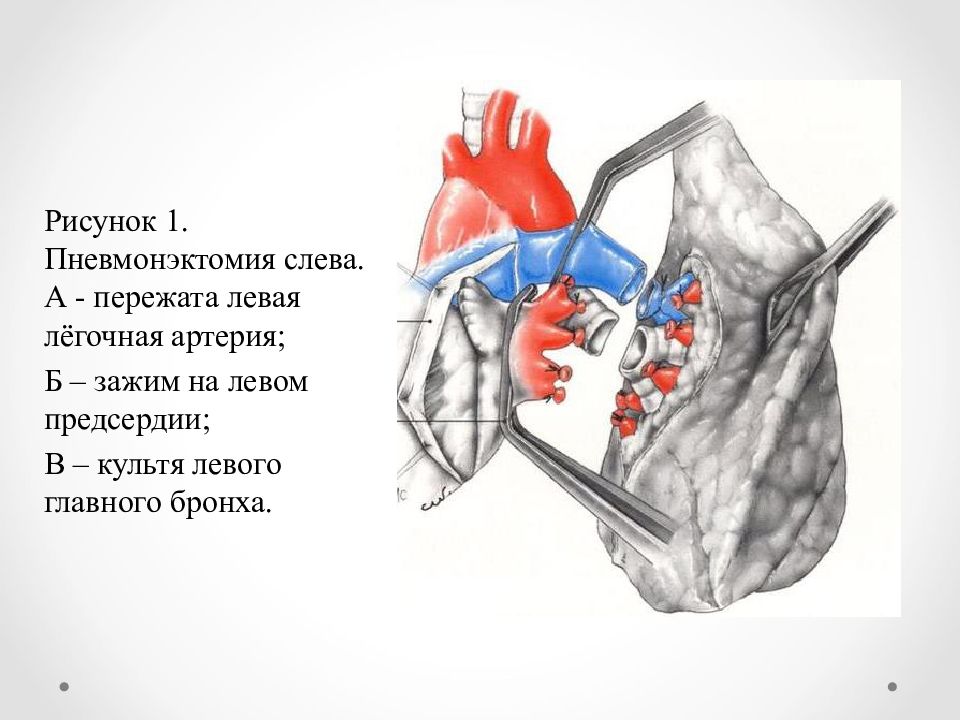 Трансплантация легких презентация