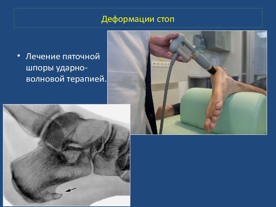 Деформации стоп презентация