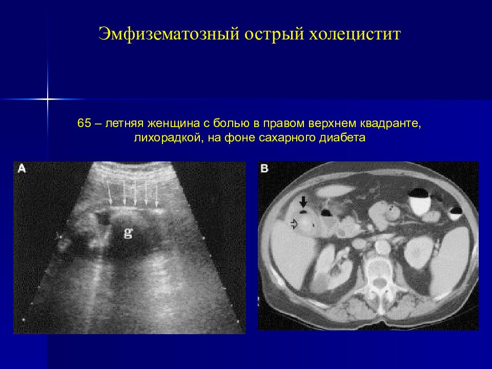 Холецистит карта смп