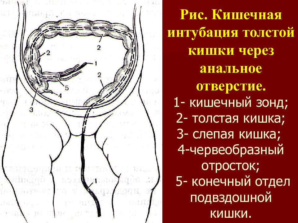 Жировой подвесок сигмовидной кишки. Червеобразный отросток толстой кишки. Купол слепой кишки схема. Заворот жирового подвеска сигмовидной кишки. Червеобразный отросток внутри стенки слепой кишки.