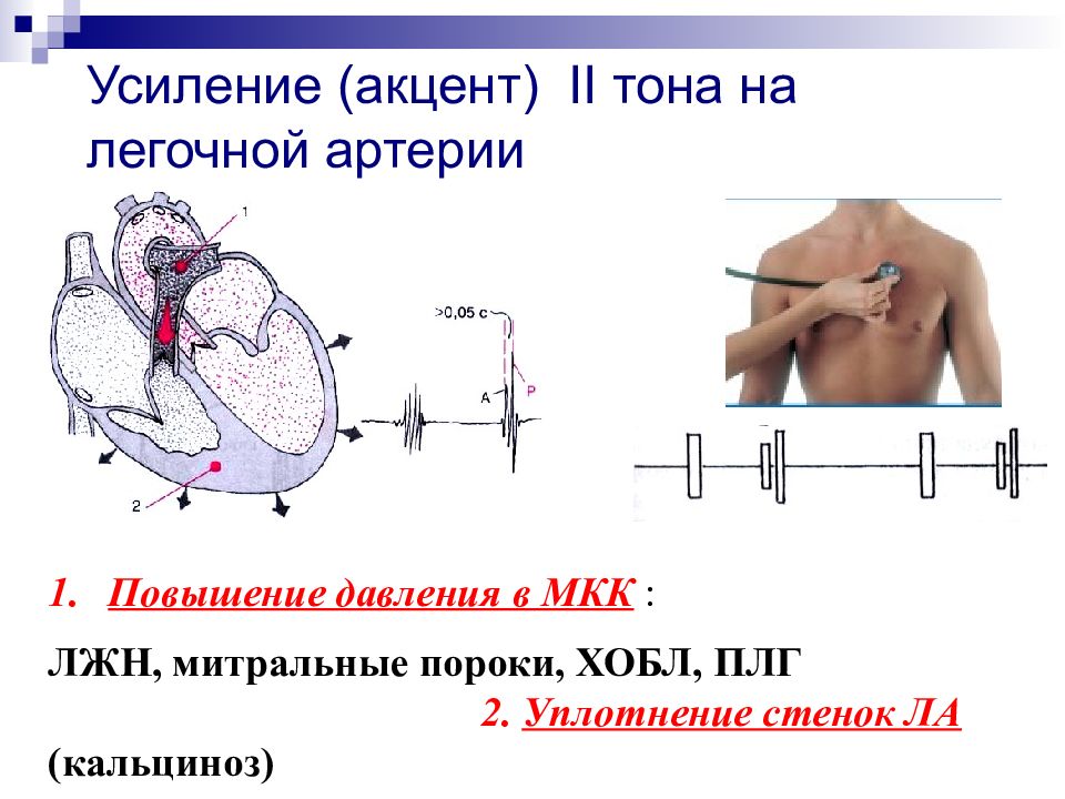 Тоны сердца акцент 2 тона