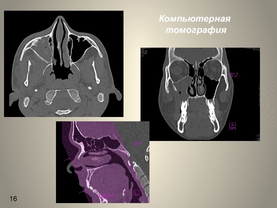 Одонтогенный гайморит презентация