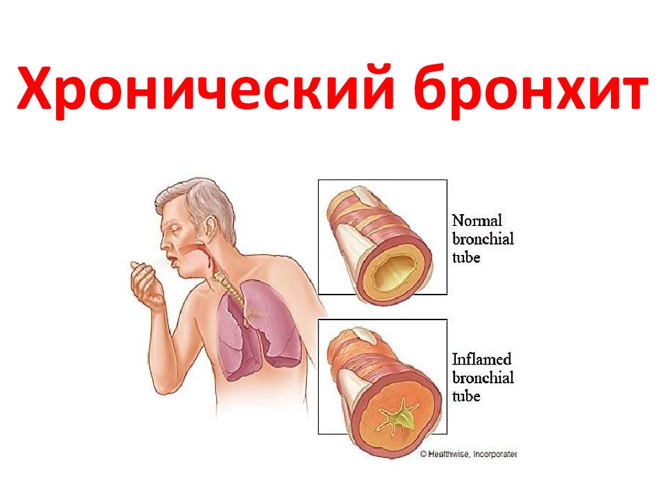 Острый бронхит у детей презентация