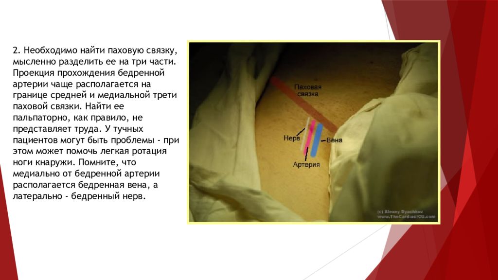 Проекционная линия бедренной артерии. Как открыть паховую Вену. Проекция бедренной артерии.