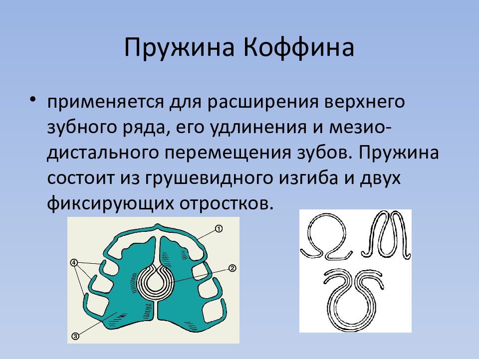 Пружина коффина. Аппарат с пружиной Коффина. Ортодонтический аппарат с пружиной Коффина. Пластинка с пружиной Коффина.