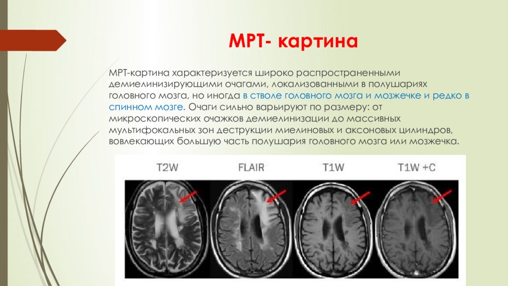 Сосудистый очаг в головном мозге что это. ПМЛ мрт прогрессирующая мультифокальная лейкоэнцефалопатия. Прогрессирующая мультифокальная лейкоэнцефалопатия мрт. Лейкоэнцефалопатия головного мозга мрт. Мультифокальное поражение головного мозга мрт.