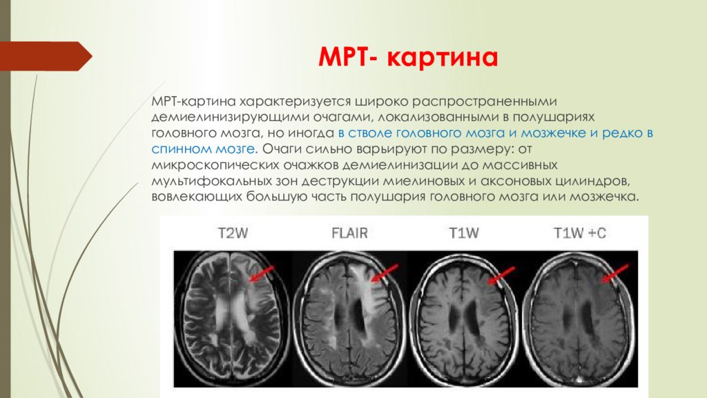 Мр картина очагов. Прогрессирующая мультифокальная лейкоэнцефалопатия ПМЛ мрт. Прогрессирующая мультифокальная лейкоэнцефалопатия мрт. Лейкоэнцефалопатия головного мозга мрт. Прогрессирующая мультифокальная лейкоэнцефалопатия кт.