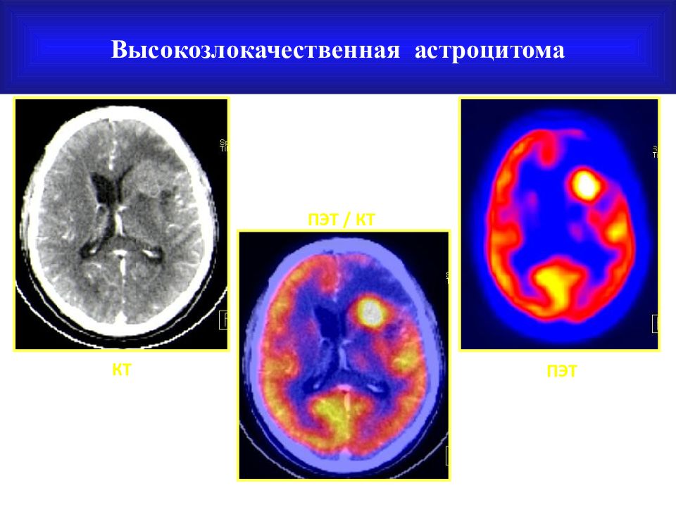 Пэт кт баллы. Диффузная астроцитома ПЭТ-кт. ПЭТ кт. ПЭТ-кт во Владимире.