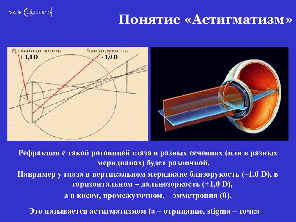 Презентация на тему астигматизм