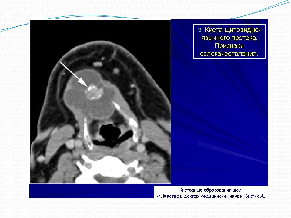 киста мюллерова протоков. киста протока. киста протока. узи общего желчного протока. киста щитовидно-язычного протока мрт.