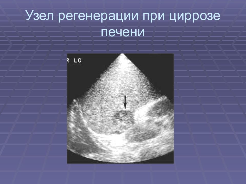 Увидит ли узи цирроз печени. Узлы регенерации печени при циррозе на УЗИ. Узел регенерации в печени на УЗИ.