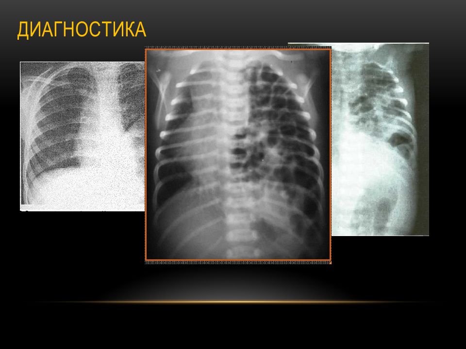 Диафрагмальные грыжи у детей презентация