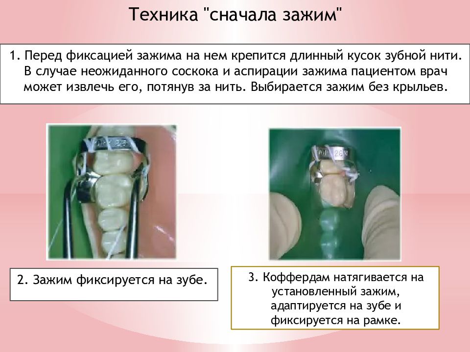 Изоляция рабочего поля матричные системы презентация