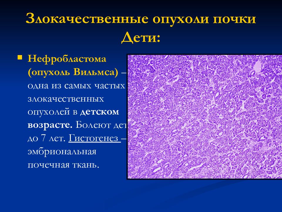 Эпителиальные опухоли патанатомия. Опухоль Вильмса гистология. Опухоли классификация патологическая анатомия. Опухоли почек классификация патологическая анатомия. Новообразования почки патанатомия.