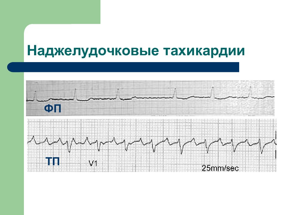 Наджелудочковая тахикардия презентация