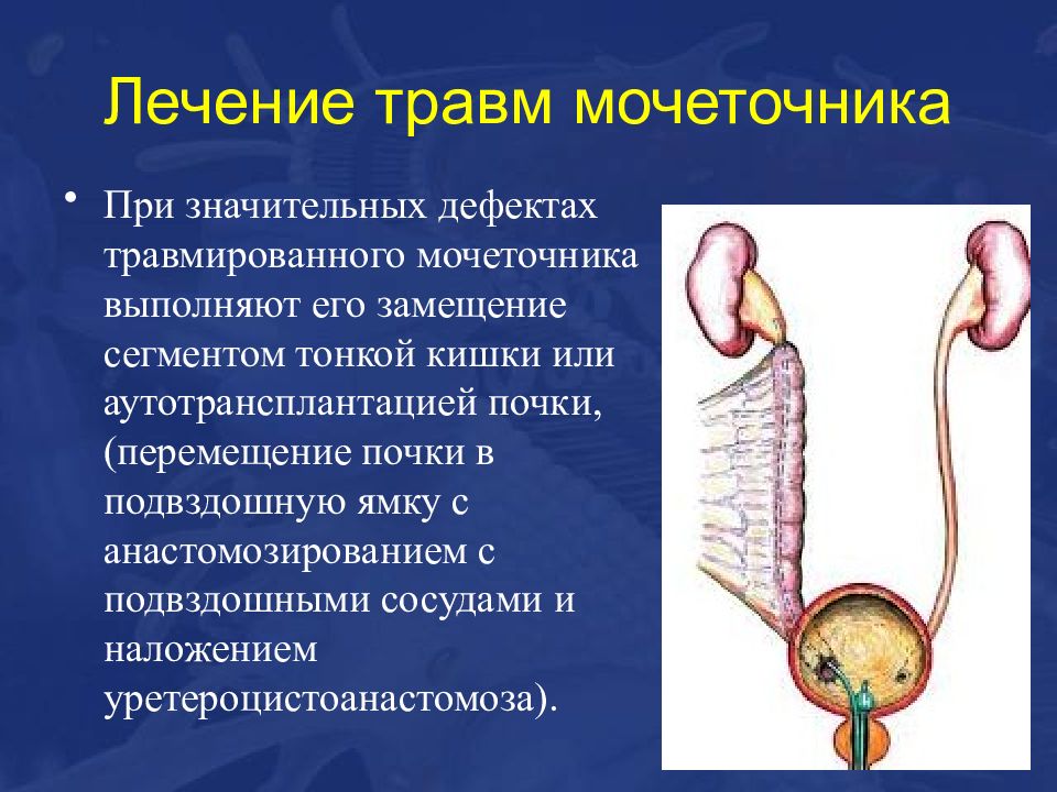 Травмы органов мочевыделительной системы презентация