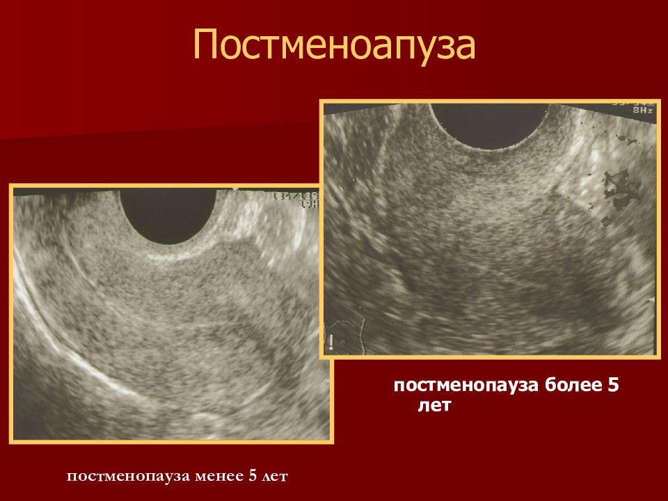 Гиперплазия эндометрия в постменопаузе отзывы