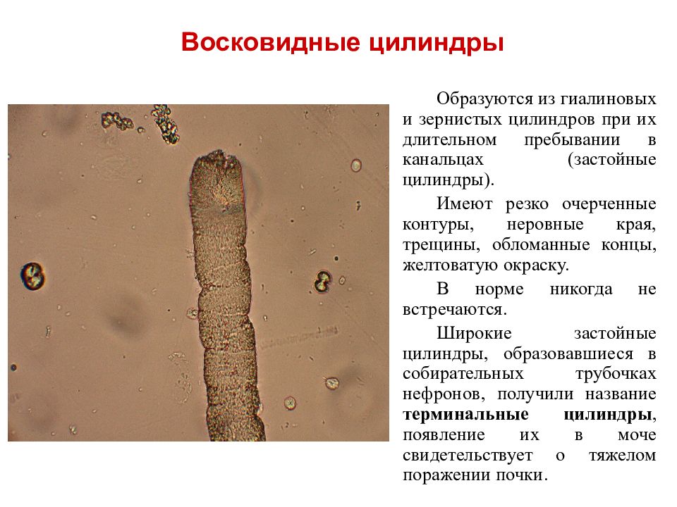 На наличие цилиндров при микроскопии осадка мочи указывает картина