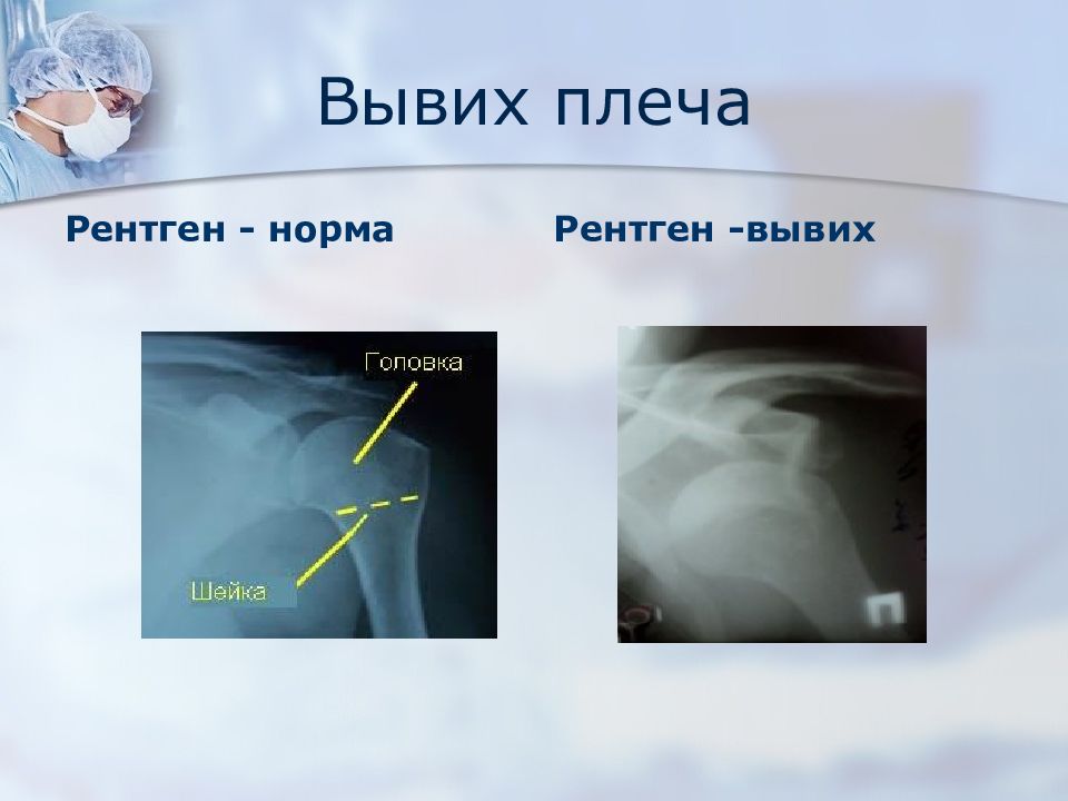 Вывих плеча. Вывих плечевого сустава рентген. Подвывих плечевого сустава рентген. Плечевой сустав рентген норма подвывих. Подвывих плеча рентген.