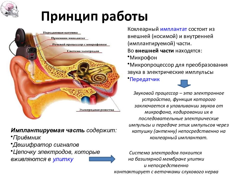 Слуховой аппарат внутреннего уха. Кохлеарный имплантат нейросенсорная тугоухость. Кохлеарная имплантация уха. Кохлеарный имплант кохлеарная имплантация. Кохлеарный неврит слухового нерва.