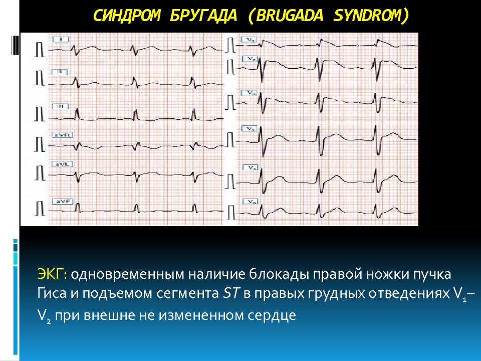 Синдром бругада презентация