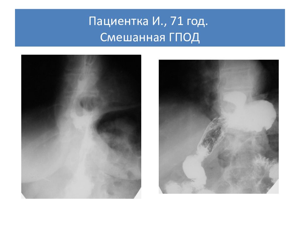 Классификация грыж пищеводного отверстия диафрагмы. Кардиофундальная грыжа рентген. Степени грыжи пищеводного отверстия диафрагмы. Параэзофагеальные грыжи. Грыжа пищеводного отверстия диафрагмы рекомендации.