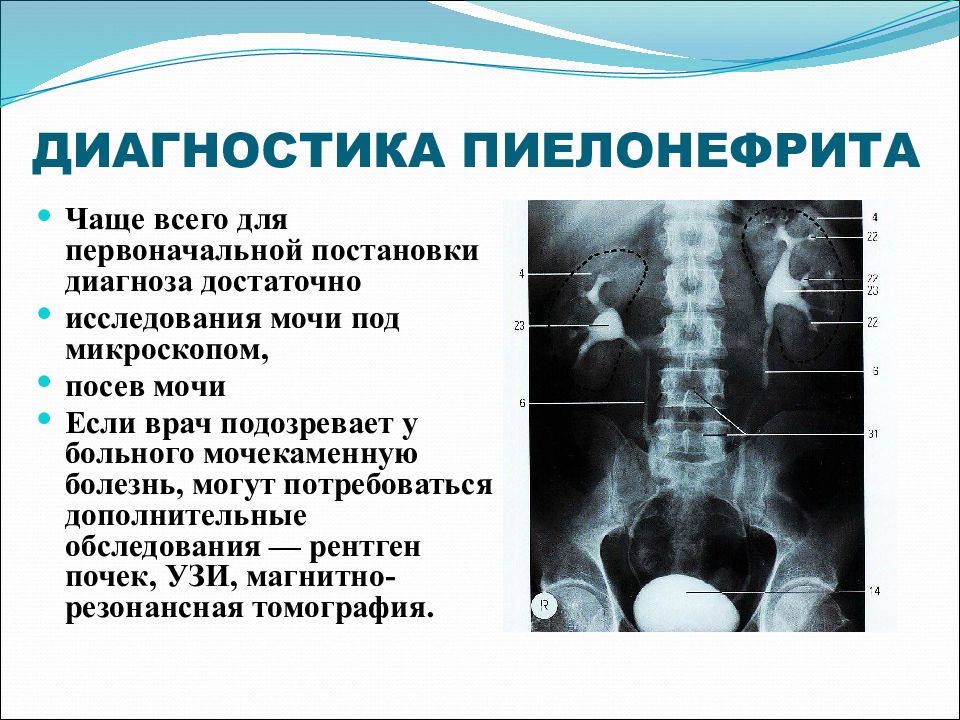 Презентация по терапии пиелонефрит