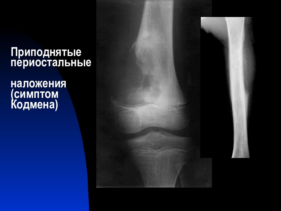 Остеосаркома симптомы. Рентгенологические симптомы остеогенной саркомы. Остеогенная саркома рентген. Остеогенная саркома бедренной кости кт. Параоссальная остеосаркома.