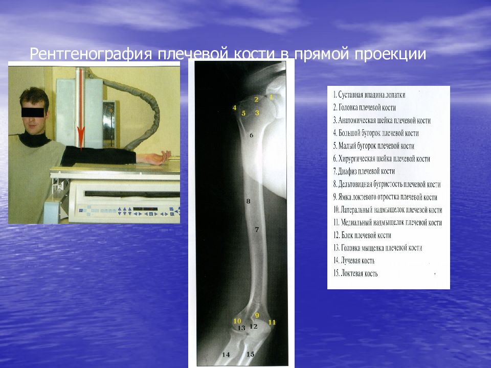 Рентген в двух проекциях. Рентген плечевой кости. Рентген длинных трубчатых костей. Рентген в прямой проекции. Снимок плечевой кости в прямой проекции.