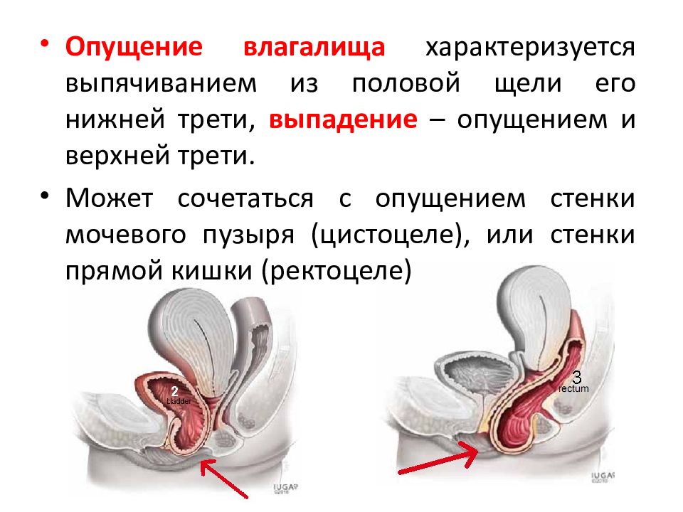 Опущение мочевого пузыря у женщин картинки