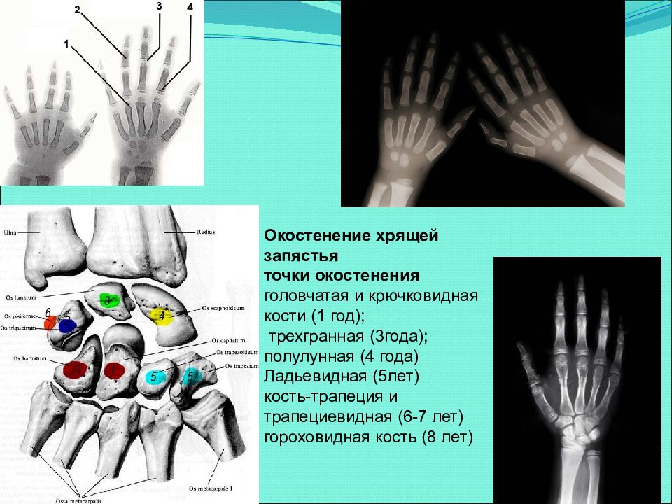 Головчатая кость запястья. Гороховидная кость запястья окостенение. Ладьевидная кость гороховидная. Ладьевидная кость стопы ядра окостенения. Костный Возраст рентгенограмма кисти рук.