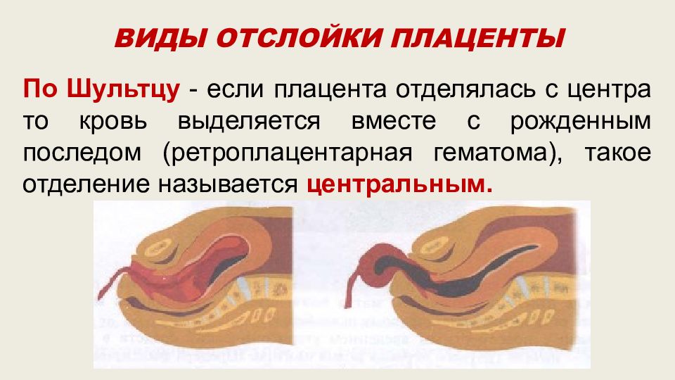 Признаки отделения плаценты. Центральное отделение плаценты. Ручное отделение плаценты и последа презентация. Ретроплацентарная гематома при отделении последа.