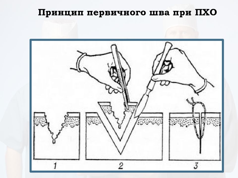 Принципы первичной хирургической обработки. Инструменты для Пхо раны. Набор для первичной хирургической обработки раны. Этапы первичной хирургической обработки раны.