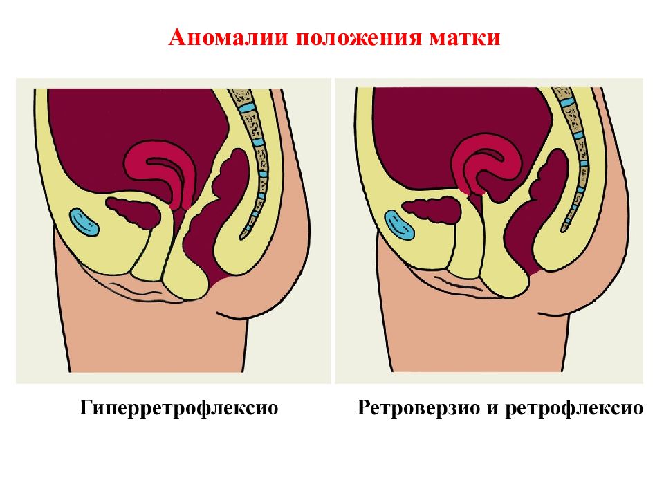 Положение матки. Аномальное расположение матки. Аномалии положения матки. Положение матки retroflexio.